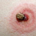 How Can I Tell If I Have Been Bitten By A Tick?
