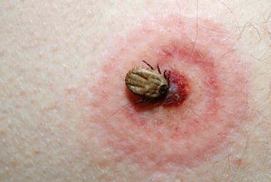 How Can I Tell If I Have Been Bitten By A Tick?