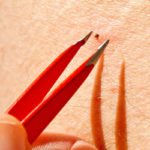 Tweezers are used to safely remove a tick - Russell's Pest Control in Knoxville TN