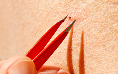 Tweezers are used to safely remove a tick - Russell's Pest Control in Knoxville TN
